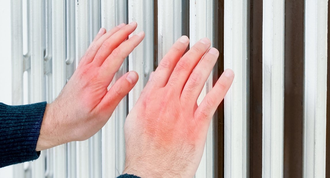 Attento ai geloni in inverno!