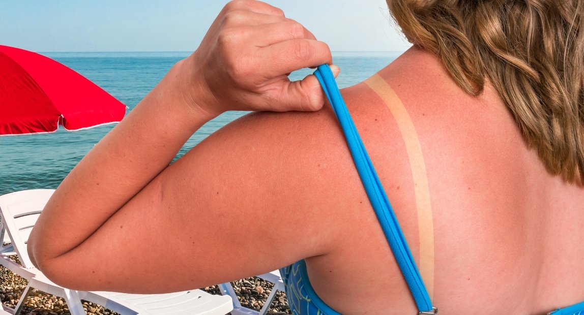 Scottature, eritemi e macchie: gli errori più comuni sotto il sole (che fanno tutti)